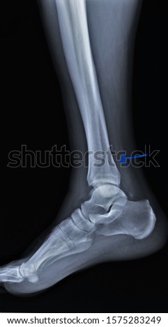 radiograph of the ankle joint with a fracture of the outer ankle without displacement, traumatology, medical diagnostics