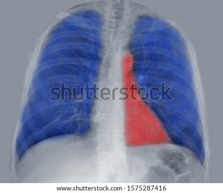 chest x-ray, red highlighted heart, blue highlighted lungs pulmonology, cardiology