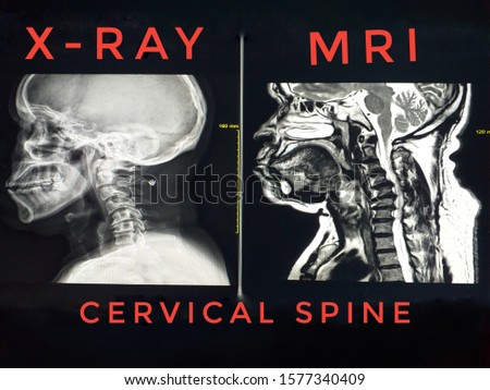 X-ray and MRI Cervical Spine:A male 64 year old A history of neck pain And numb the area of ​​the fingers and palms ,Finding cervical spondylosis and spinal cord compression.