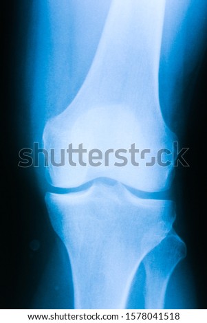 medical Xray picture of a knee