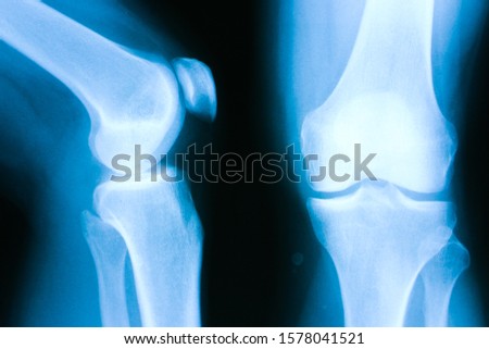 medical Xray picture of a knee