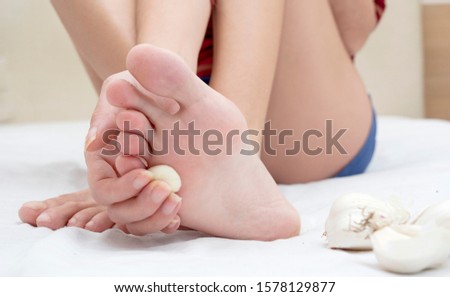 Homemade or alternative, natural treatment with garlic for verruca or plantar wart  Royalty-Free Stock Photo #1578129877
