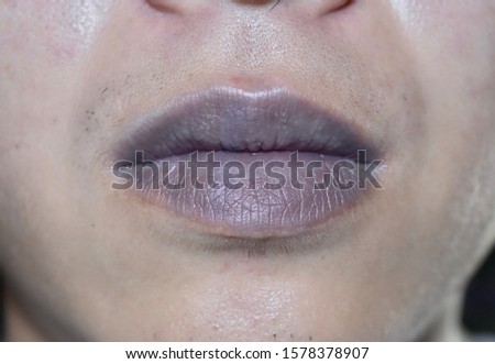 Cyanotic lips or central cyanosis at Southeast Asian, Chinese young man with congenital heart disease. Royalty-Free Stock Photo #1578378907