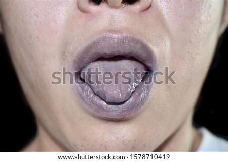 Cyanotic lips and tongue or central cyanosis at Southeast Asian, Chinese young man with congenital heart disease. Isolated on black background. Royalty-Free Stock Photo #1578710419