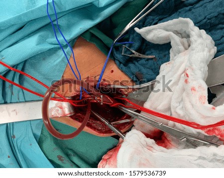 In carotid surgery, the ateria carotis is exposed and wrapped in red and blue reins