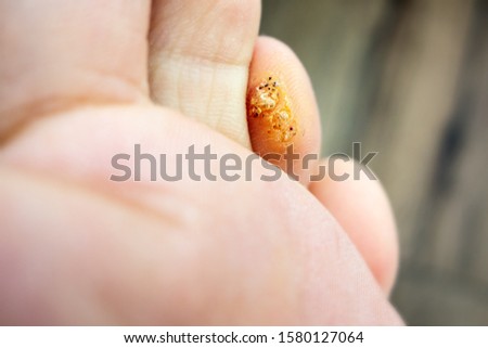 Wart (verrucae plantares) on a toe on a foot as a typical skin disease which has been cured for a short time Royalty-Free Stock Photo #1580127064