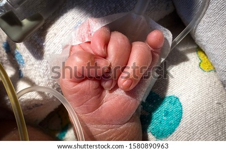 Clenched hand with overlapping fingers is characteristically seen in Edwards syndrome. Royalty-Free Stock Photo #1580890963