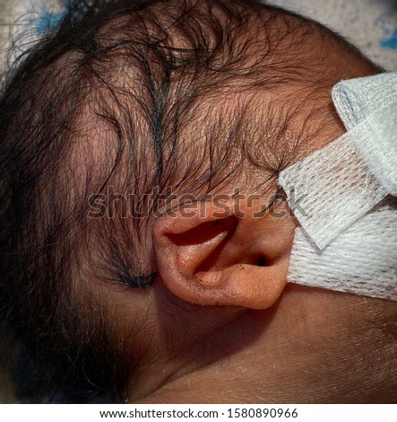 Dysplastic ears or Malformed ears and low set ears are characteristically seen in Edwards syndrome. Royalty-Free Stock Photo #1580890966