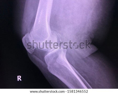 X-ray right knee Lat show small knee joint effusion. Narrowing femorotibial, patellofemoral joint spaces with osteophyte, periarticular osteopenia. Calcified popliteal A ( monckeberg atherosclerosis ) Royalty-Free Stock Photo #1581346552