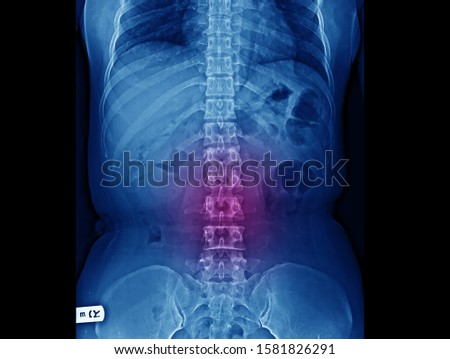Lumbar spine X-ray showing straight spine without radiographic sign of spinal infection or metastasis. 