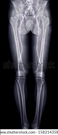 scanogram of lower extremity with Fusion CTA Femoral run off showing bone and vessel of lower limb. Royalty-Free Stock Photo #1582143586