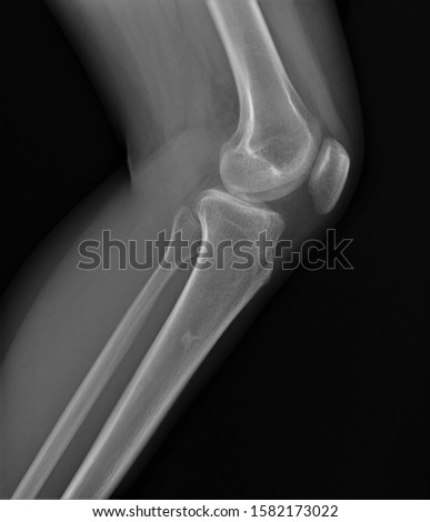 normal radiography of the knee joint in lateral projection, medical diagnostics, traumatology and orthopedics