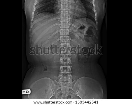 Lumbar spine X-ray showing straight spine without radiographic sign of spinal infection or metastasis. 