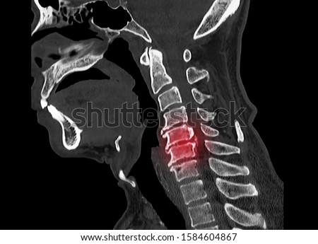 Computer tomography or CT scan of cervical spine showing ossified posterior longitudinal ligament or OPLL at C5 and C6 level. The pathology causes myelopathy and neck pain.  Royalty-Free Stock Photo #1584604867