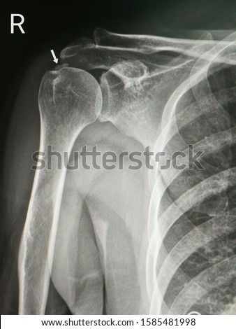 X-ray image shows right shoulder with calcified supraspinatus tendon. Royalty-Free Stock Photo #1585481998