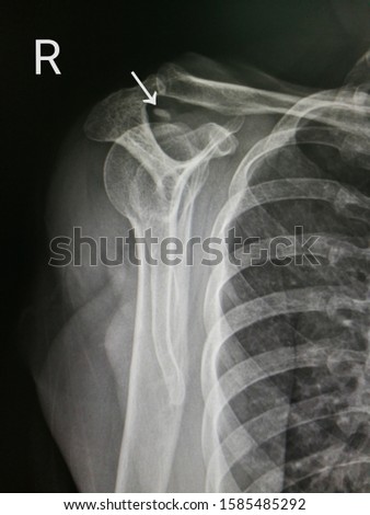 X-ray image(lateral scapula view) shows right shoulder with calcified supraspinatus tendon. Royalty-Free Stock Photo #1585485292