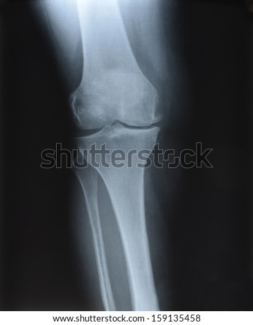 X-ray picture showing knee joints 