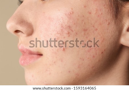 Teenage girl with acne problem on beige background, closeup Royalty-Free Stock Photo #1593164065