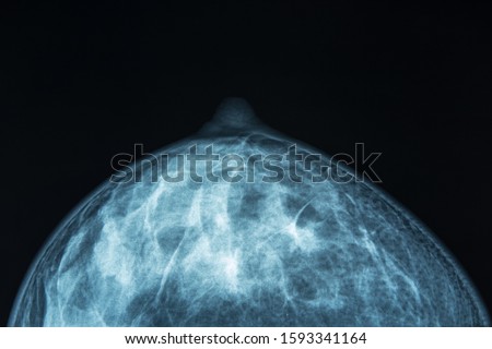medical image of a bosom x-ray