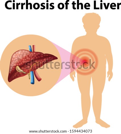 Diagram showing cirhosis of the liver illustration
