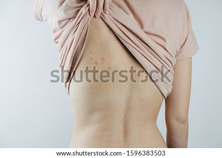 Damaged skin on female's back. Bedbug bites, moosquito bites or skin disease on human body Royalty-Free Stock Photo #1596383503