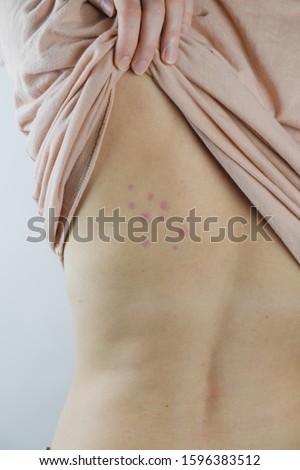 Damaged skin on female's back. Bedbug bites, moosquito bites or skin disease on human body, vertical shot