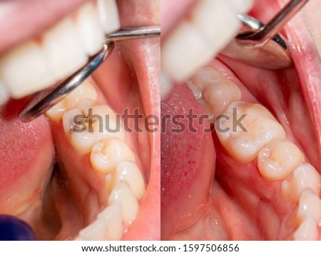 Dental caries. Filling with dental composite photopolymer material using Rubber Dam. The concept of dental treatment in a dental clinic Royalty-Free Stock Photo #1597506856