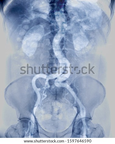 CTA whole aorta showing abdominal aorta and left, right iliac artery showing aortic dissection . Royalty-Free Stock Photo #1597646590
