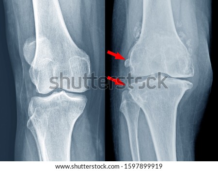 Osteoarthritis (OA) knee . film x-ray view of knee narrowing of joint space.