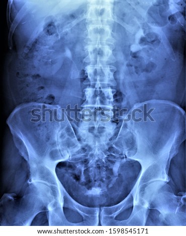 x-ray of the abdominal cavity and pelvis in direct projection, medical research,urography Royalty-Free Stock Photo #1598545171