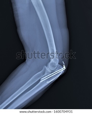 x-ray with a fracture of the ulnar process fixed by spokes