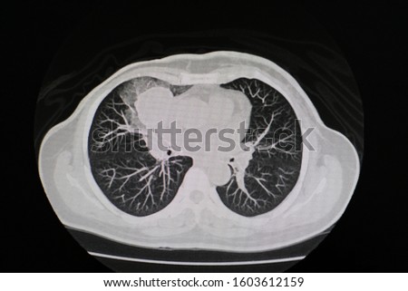 CT scan (computed tomography) of chest organs.