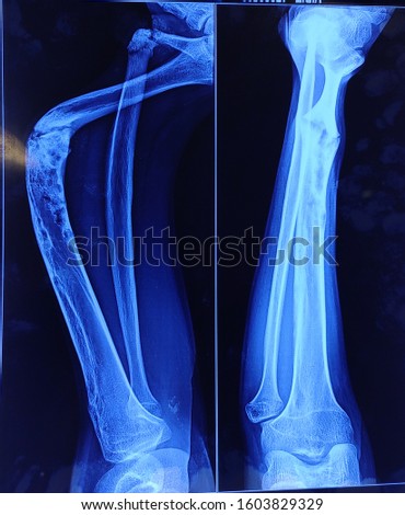 X ray of lower limb with disease conditions. Royalty-Free Stock Photo #1603829329