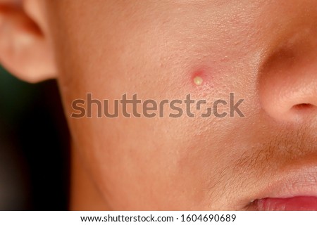 Inflammatory Purulent acne closeup on face of young man asian. Purulent pimple on the skin on the face. Royalty-Free Stock Photo #1604690689