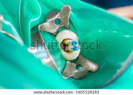 photo endodontic treatment of dental canals in the lower molar permanent tooth molar with endodontic file with apex locator, tooth with clamp attached to it by cofferdam Royalty-Free Stock Photo #1605528283