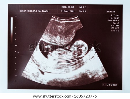 Baby on ultrasound. An ultrasound scan of a baby in the womb. 20 weeks gestation.