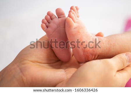 Infant legs with red dry skin. Suffering from allergy of milk formula or other food. Closeup.shot Royalty-Free Stock Photo #1606336426