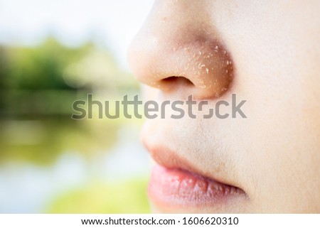 Allergic young woman have eczema dry nose on winter season,female people peeling skin with seborrheic dermatitis,atopic dermatitis symptom on her nose,flaky skin on the face or allergic reaction  Royalty-Free Stock Photo #1606620310