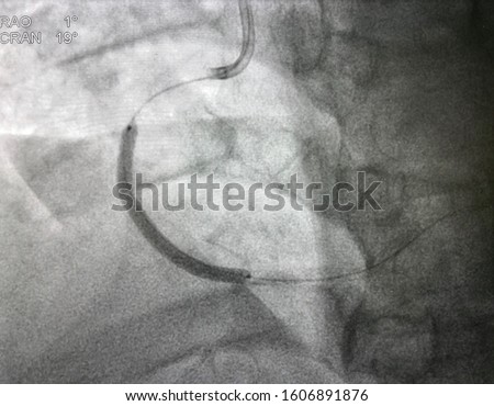 A coronary stent deployed at mid right coronary artery (RCA) during percutaneous coronary intervention (PCI). Royalty-Free Stock Photo #1606891876