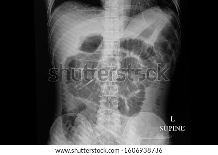 An abdominal  supine x-ray film of a male patient with mechanical bowel obstruction. Air in dilated intestinal loop. Royalty-Free Stock Photo #1606938736