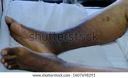 Hyperpigmented lower limb with lipodermatosclerosis and varicose vein in Chronic Venous Insufficiency. Royalty-Free Stock Photo #1607698291