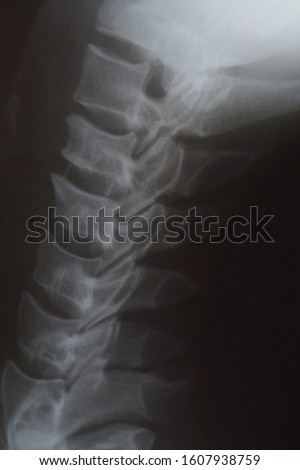 Magnetic resonance image of human spine. X-ray of the spinal column, side view. Lateral xray of neck and cervical spine, fixation with pedicle screw and rod rod of C6/7. Medical health care concept.