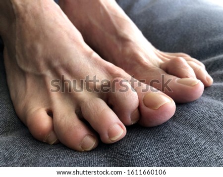 Woman's foot with hammer toe.  Royalty-Free Stock Photo #1611660106