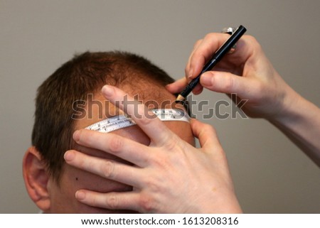 Hair transplantation is a surgical technique that moves hair follicles from a part of the body. Royalty-Free Stock Photo #1613208316