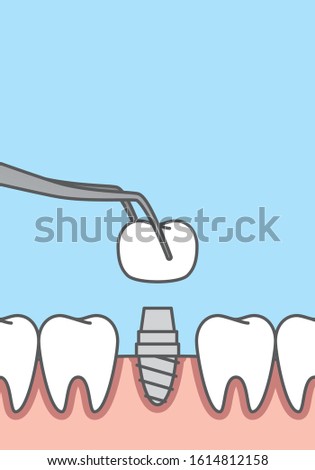 Blank banner Implant teeth illustration vector on blue background. Dental concept.