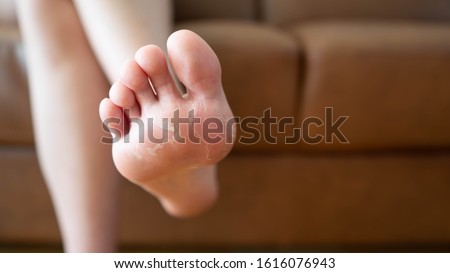 Close up of peeling and cracked foot. Causes of peeling foot included fungal infection (athlete's foot), dermatitis (eczema), sunburn, dry skin, dehydration or sweaty feet. Health care concept. Royalty-Free Stock Photo #1616076943