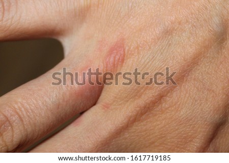 Female hand, close-up, top view. On the arm burn of the first degree. Burn from kitchen oil. Royalty-Free Stock Photo #1617719185