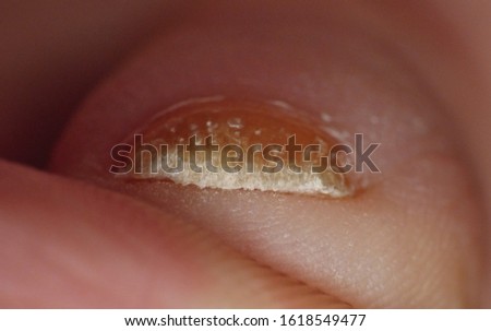 Toenail fungus Close up macro photography of fungus growing on males toes