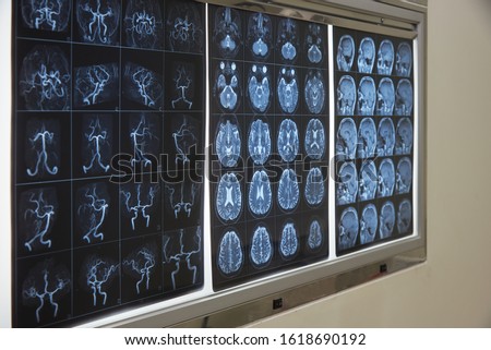 Brain magnetic resonance imaging on the lightbox for analyzing in operating room