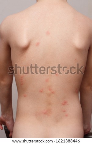 Insect bites of a bedbug such as Cimex lectularius or Cimex hemipterus on the child's body after returning from a vacation tourist trip from another city